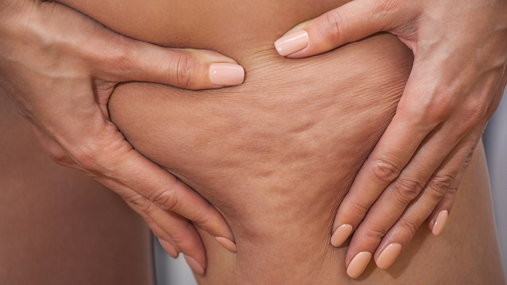 Why Some Women Get Cellulite and Others Don’t