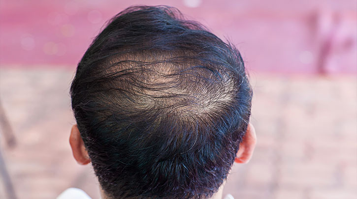 Best Treatments for Thinning Hair for Men and Women