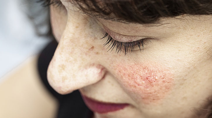 How to Talk to Your Doctor About Rosacea