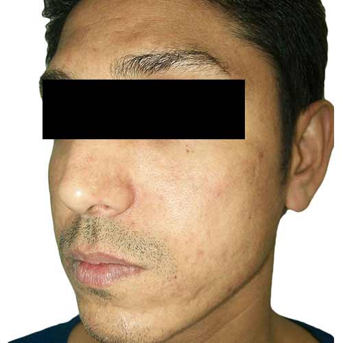 acne scar reduction - after