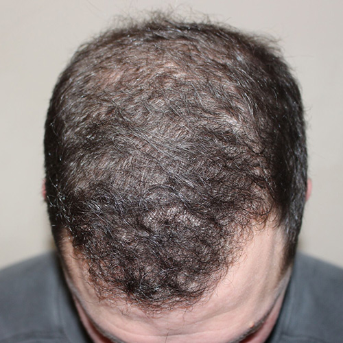 hair restoration - after