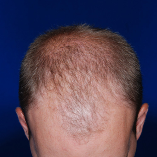 hair restoration - before