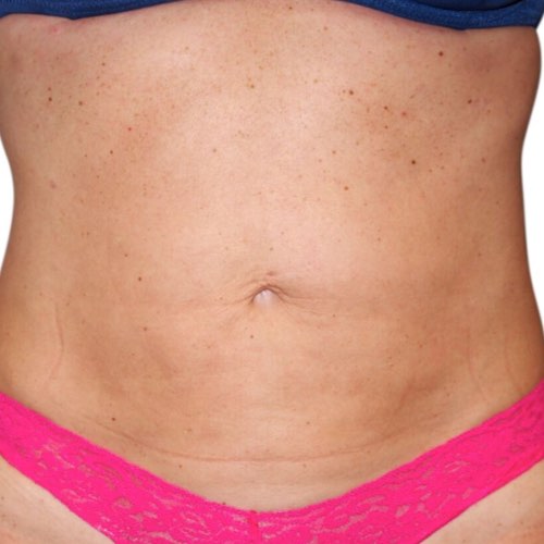 Venus Body Contouring & Skin Tightening - Deja Vu Med Spa