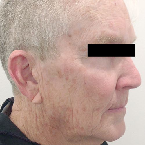 tribella before