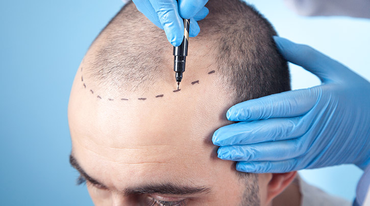 Know the Risks of Going to a Foreign Country for Hair Restoration