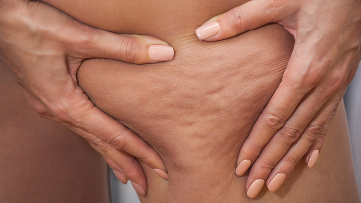 Why Some Women Get Cellulite and Others Don't