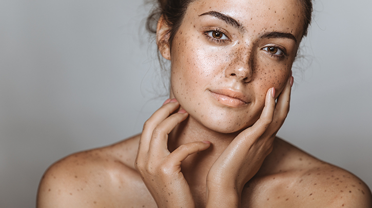 What Is Melasma and How to Treat It