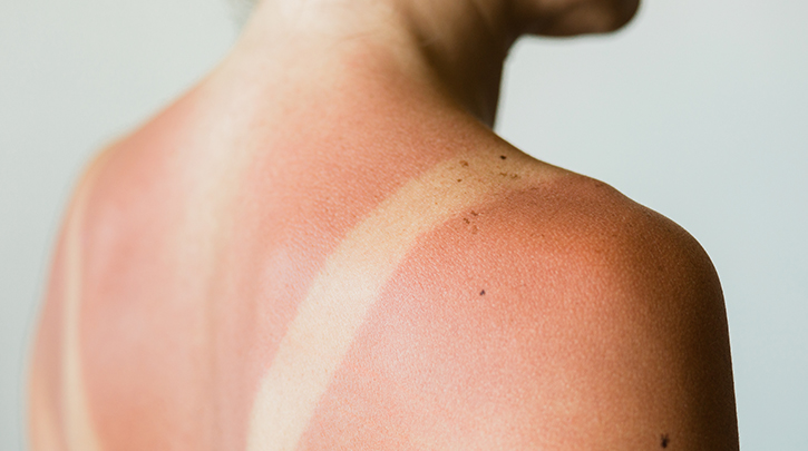 How to Care for Your Skin After Sun Exposure Or Sunburn 