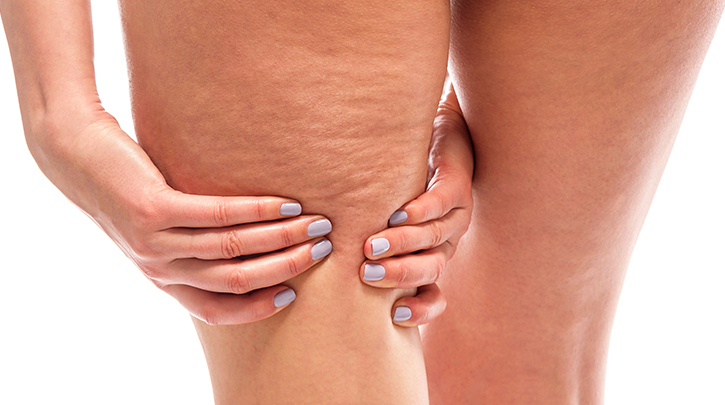What Causes Cellulite and How to Get Rid of It