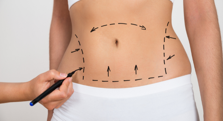 What To Expect After Liposuction | Venus Treatments