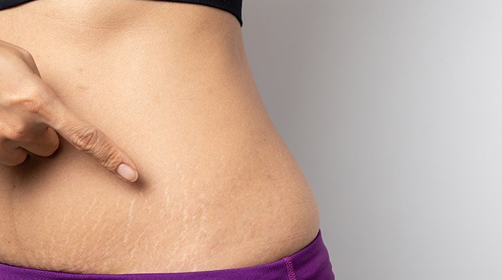 Why Some People Get Stretch Marks And Others Don't | Venus Treatments